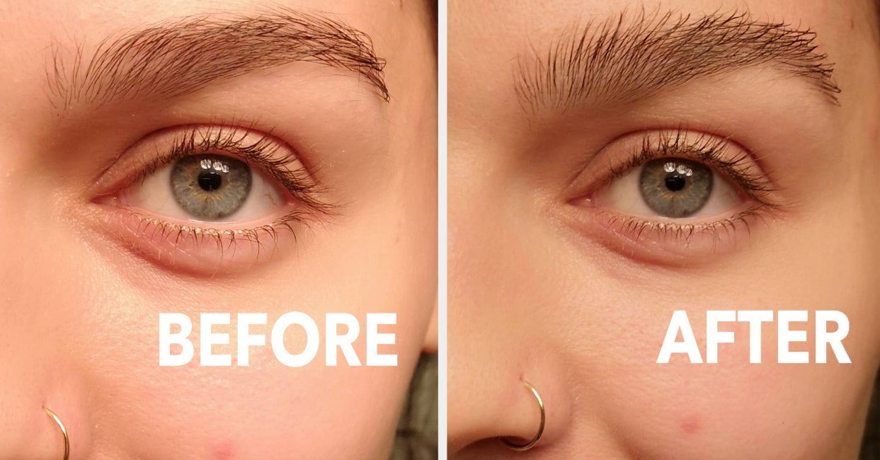 Brow Enhancement